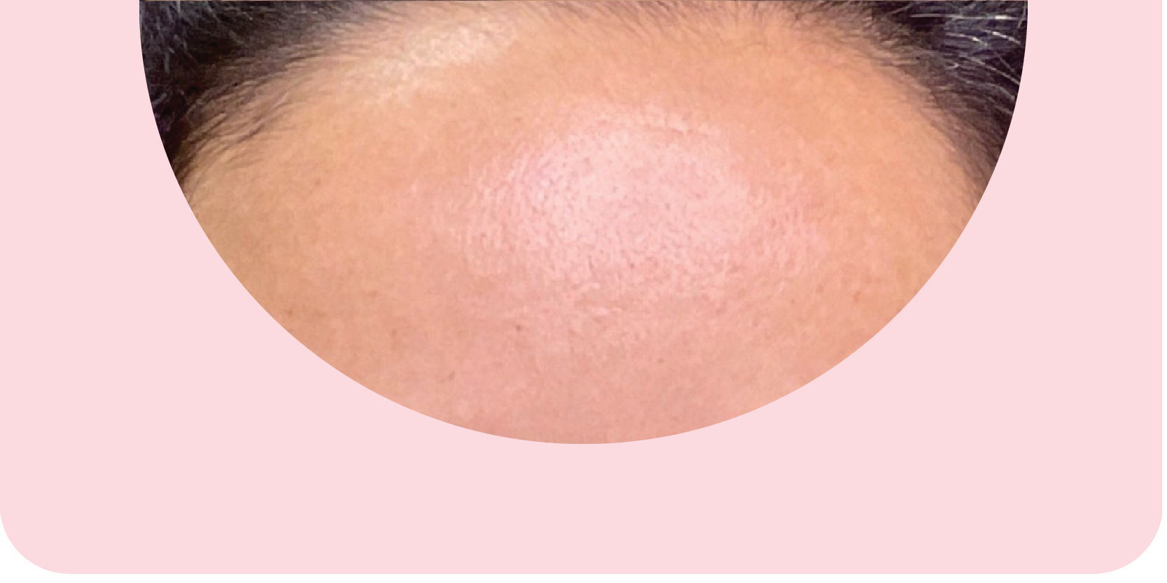 Botox & Dysport after treatment