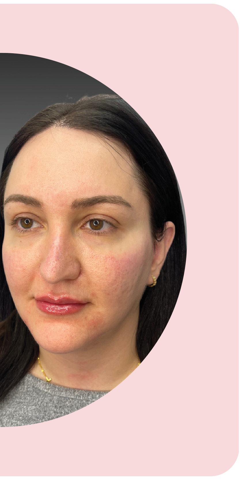 Facial Balancing after treatment