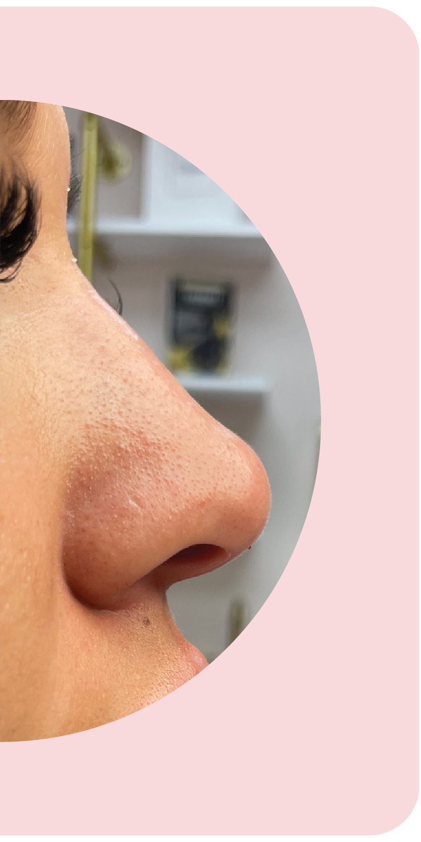 Nose Filler after treatment