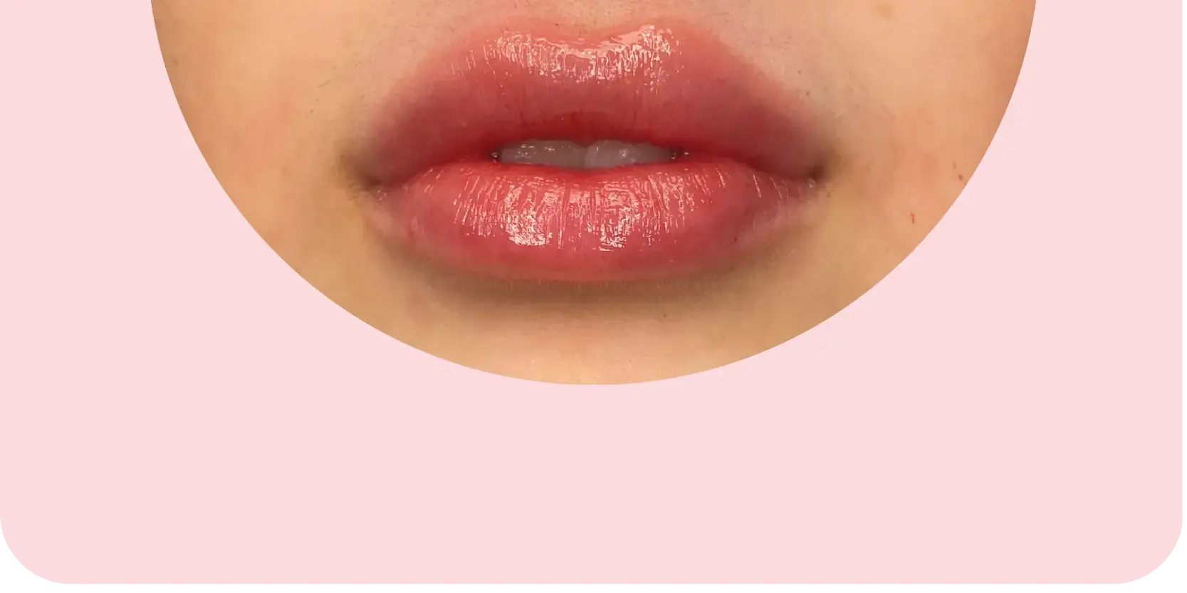 Lip Filler after treatment