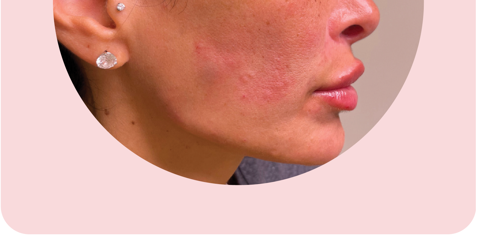 Chin Filler after treatment