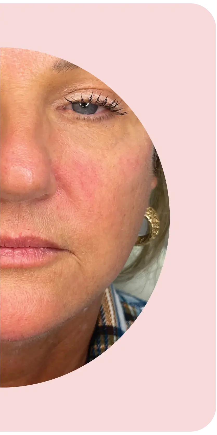Facial Filler after treatment