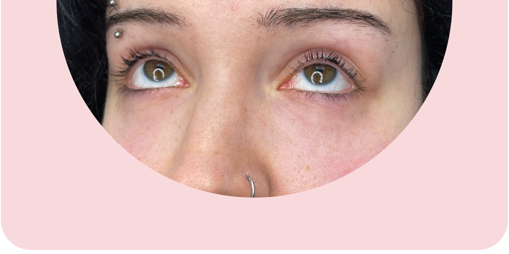 Undereye Filler after treatment