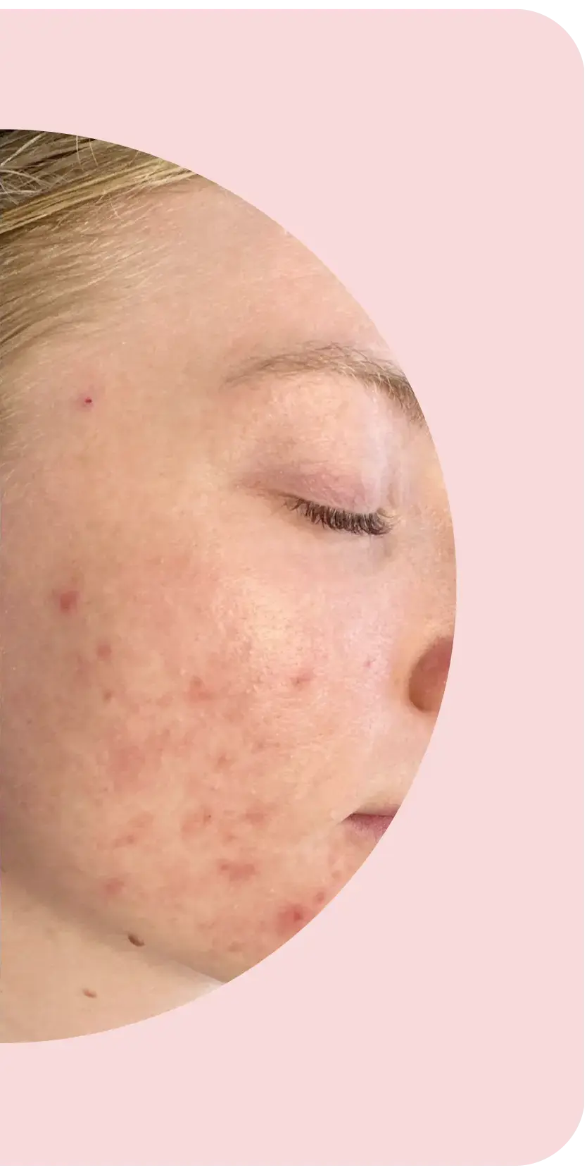 Acne Bootcamp after treatment