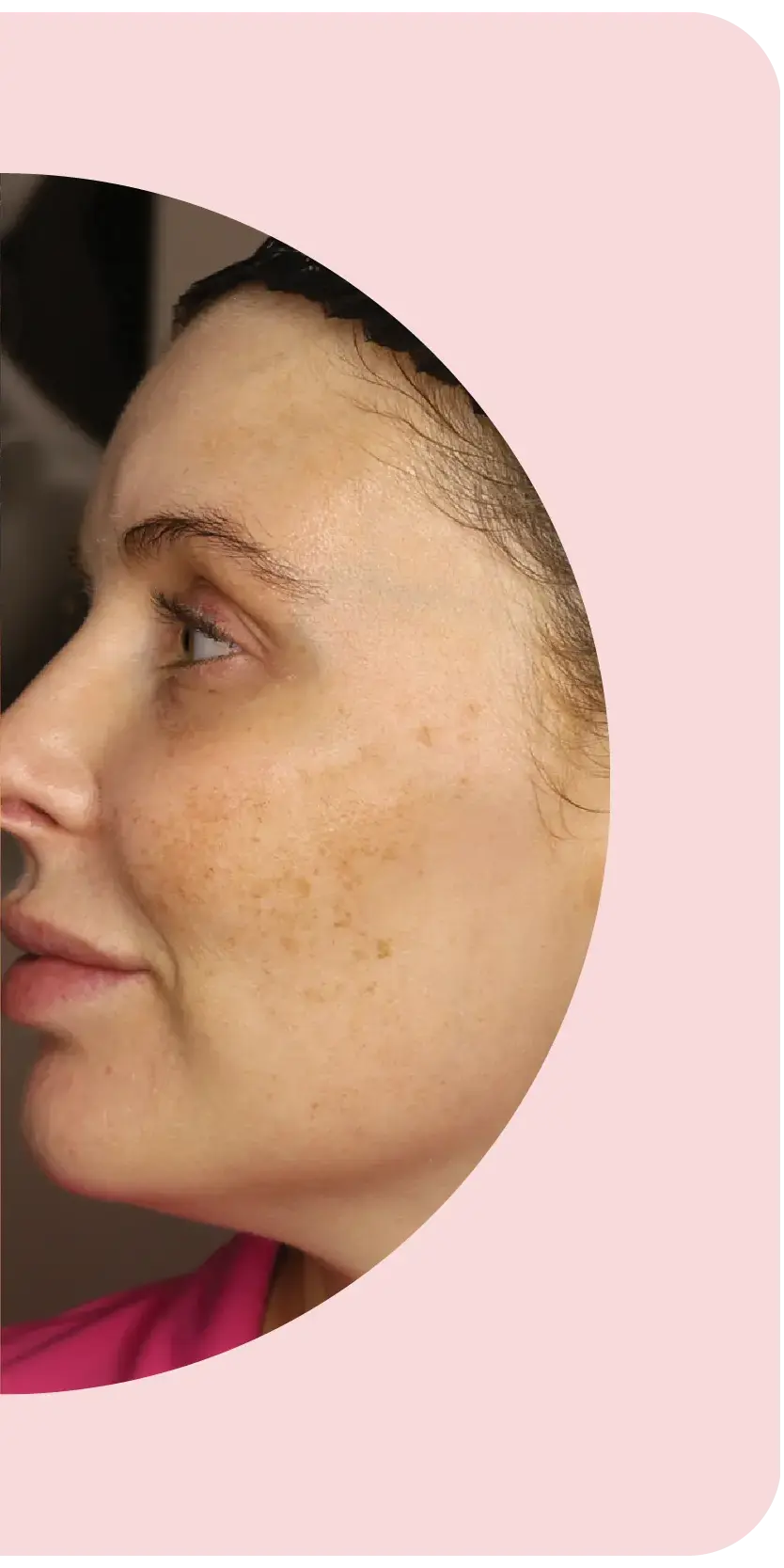 Melasma Bootcamp after treatment