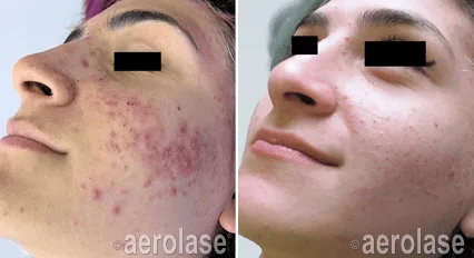 Aerolase treatment Images before and after by Crawford Cosmetics in MI