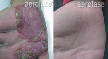 Psoriasis by Crawford Cosmetics in MI