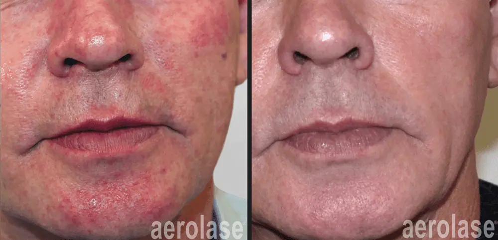 Rosacea by Crawford Cosmetics in MI