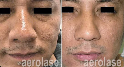 Aerolase Images before and after by Crawford Cosmetics in MI