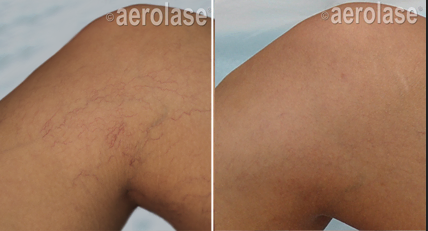 Vein & Angioma Removal by Crawford Cosmetics in MI